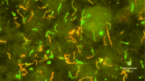 Chronic Lyme Disease